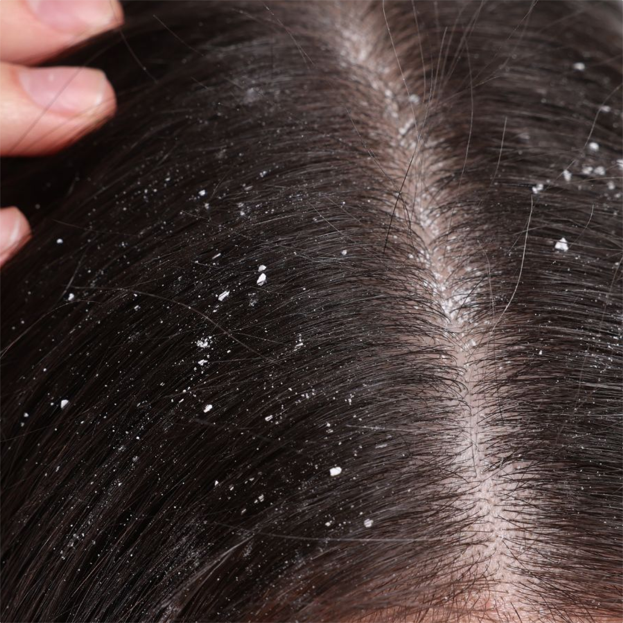Dandruff