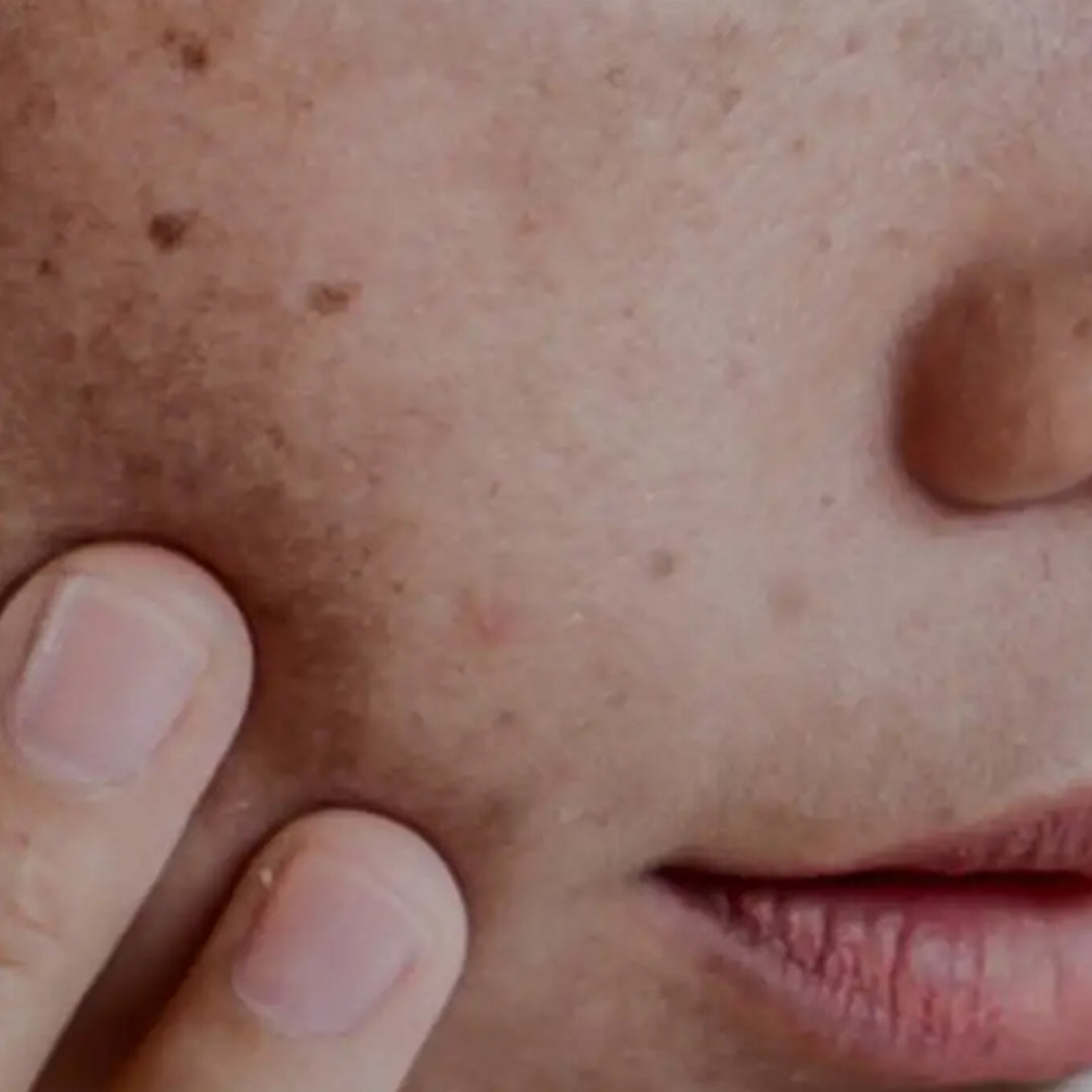 Acne & Pigmentation